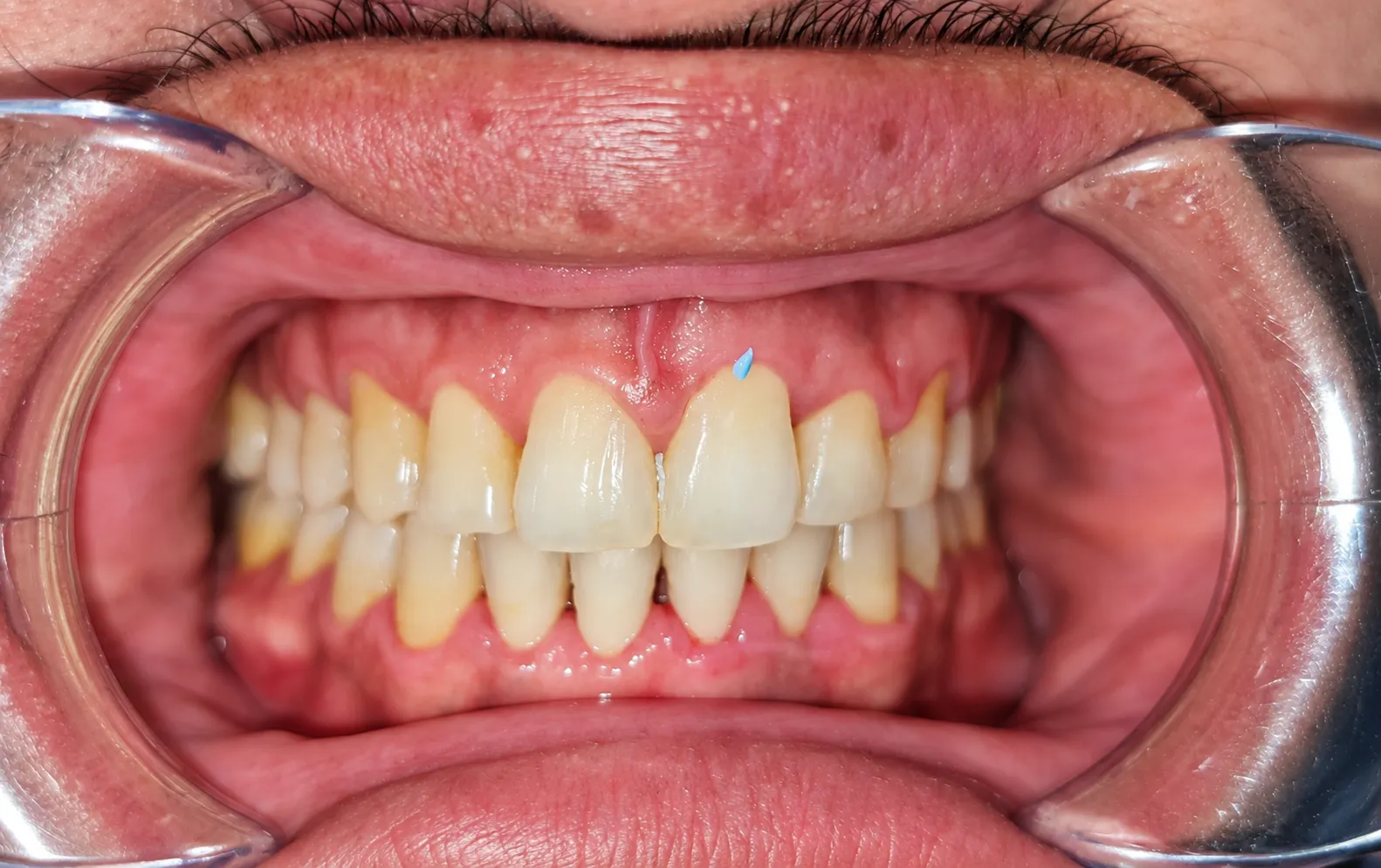 Case 02 - Frontal - After
