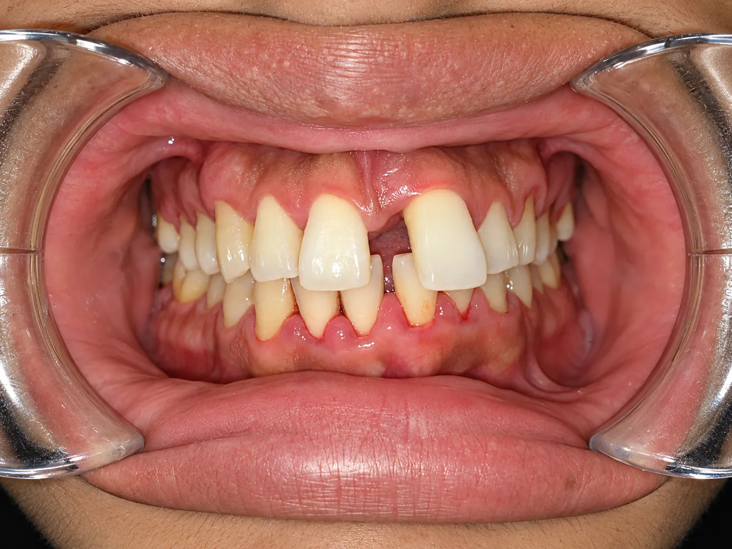 Case 02 - Frontal - Before