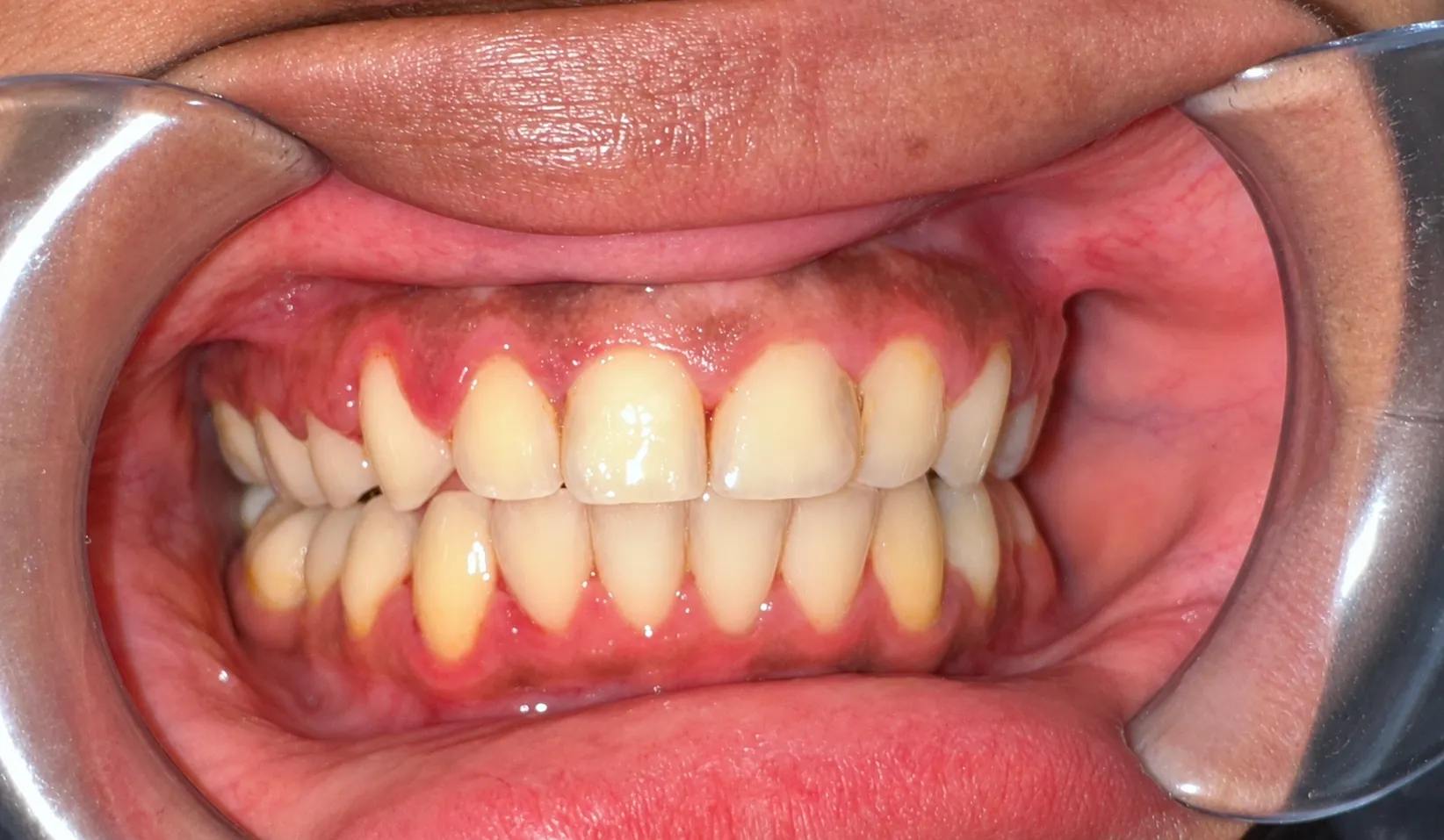 Case 03 - Frontal - After