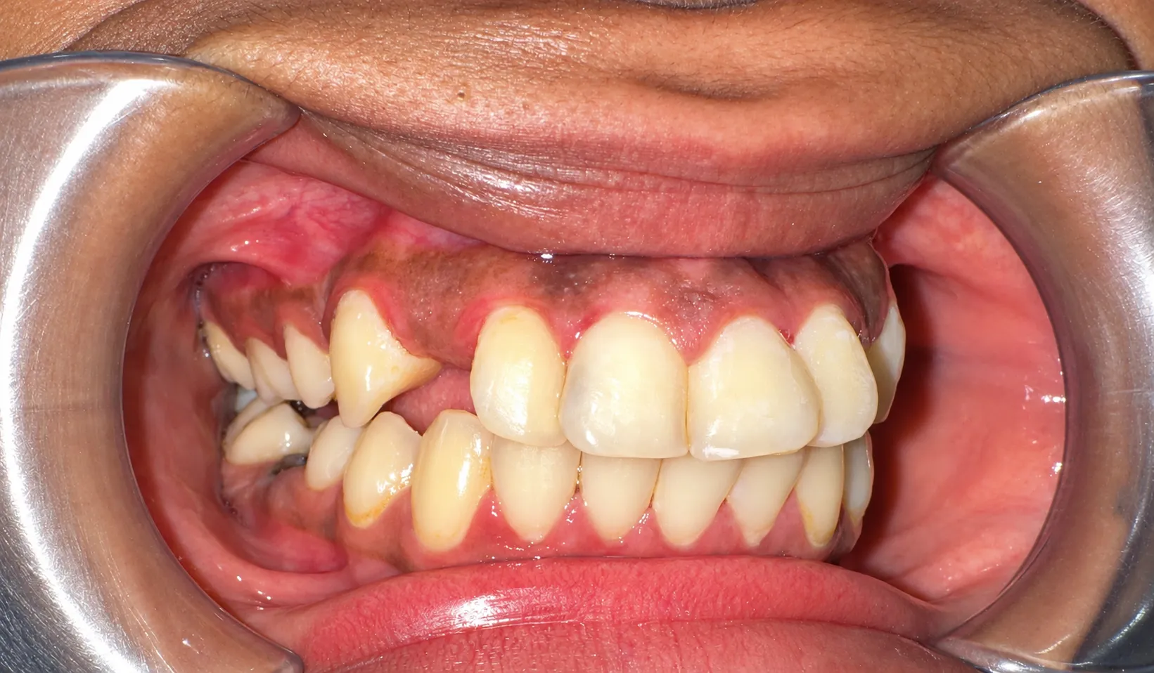 Case 03 - Frontal - Before
